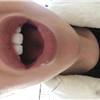 Had went to receive lip fillers in March. Left their location with a gap in my lips, to which I had to return and have them fixed. After the swelling had died down I noticed a sign