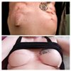 Dr. Macadam is a phenomenal plastic surgeon. After many surgeries and lots of radiation, she took my train wreck chest and did an astounding reconstruction. I never dreamed I'd hav